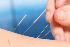 Akupunktur – hjælp med rygsmerter